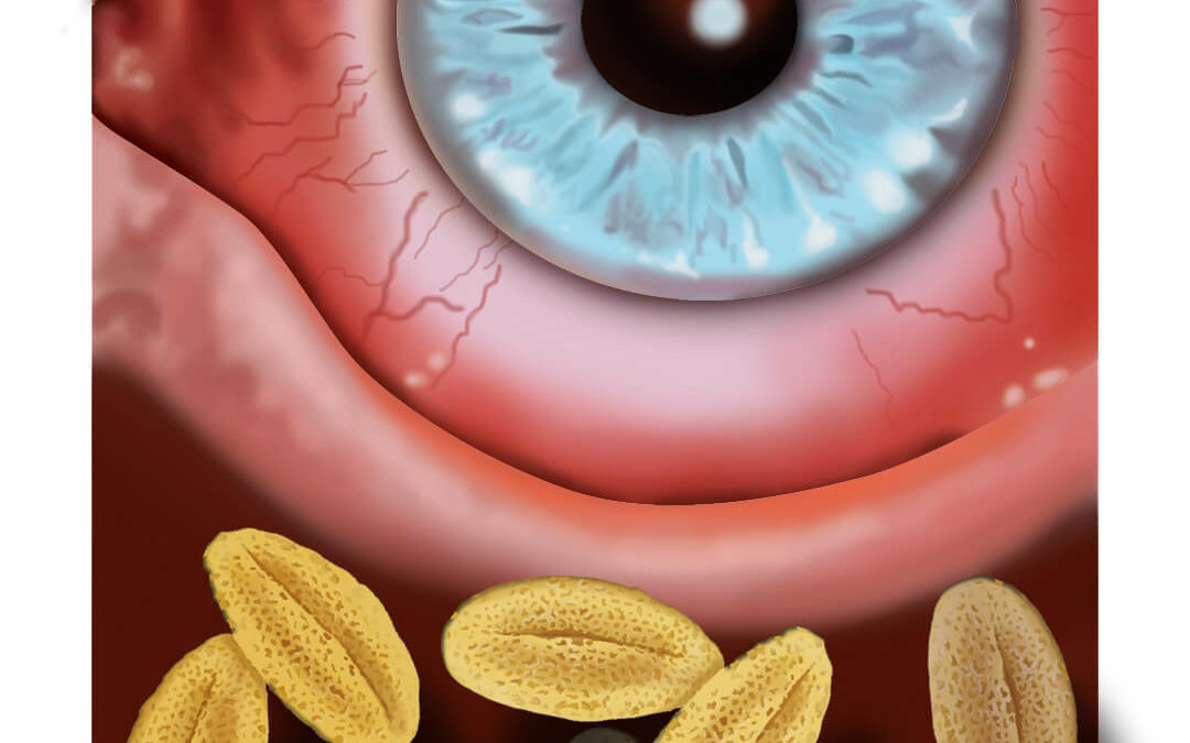 Medical illustration Allergic Conjunctivitis, digital